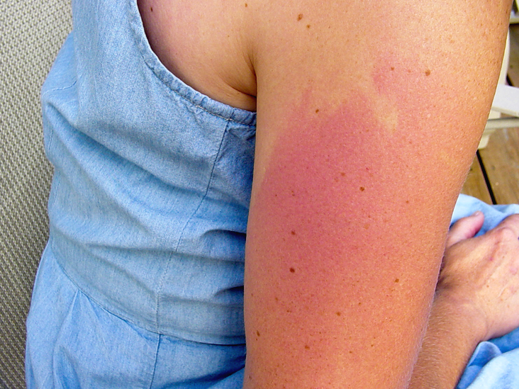 Tanning Bed Rash