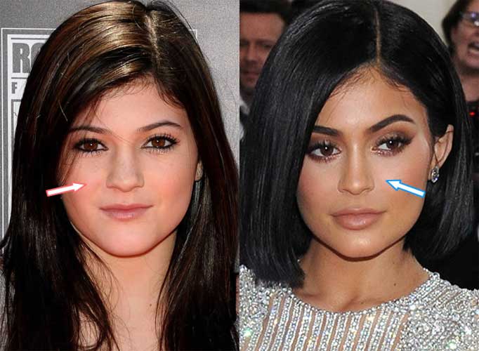 Kylie Jenner Plastic Surgery Before And After Pictures Women In The World