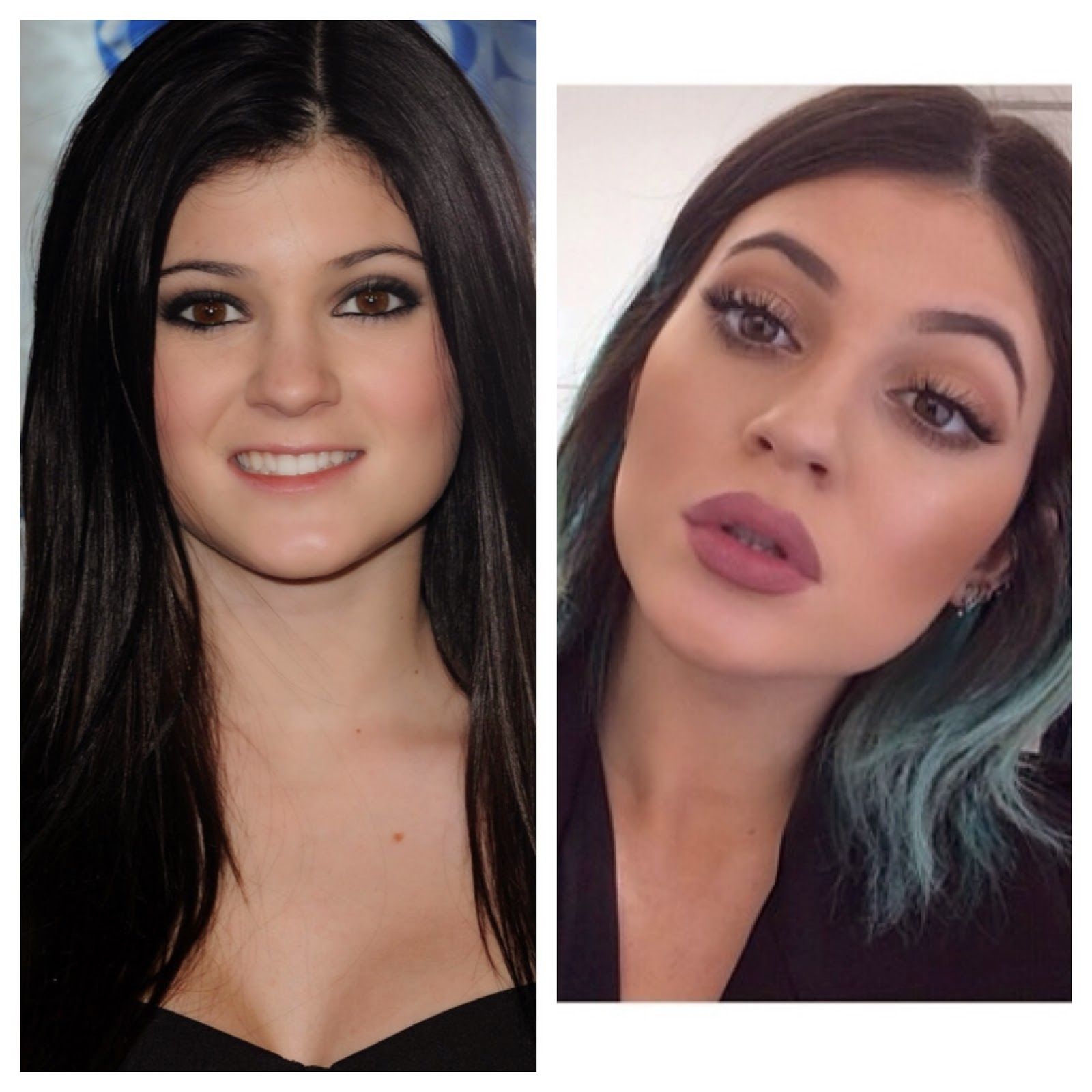 kylie jenner plastic surgery