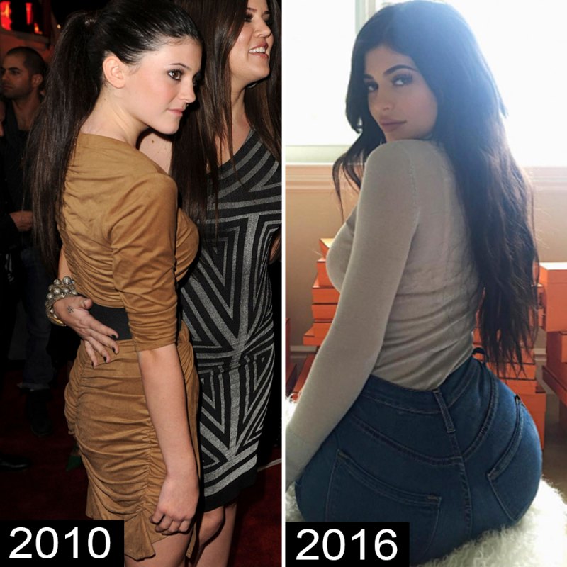 Kylie Jenner Plastic Surgery Before And After Pictures Women In The World 1887